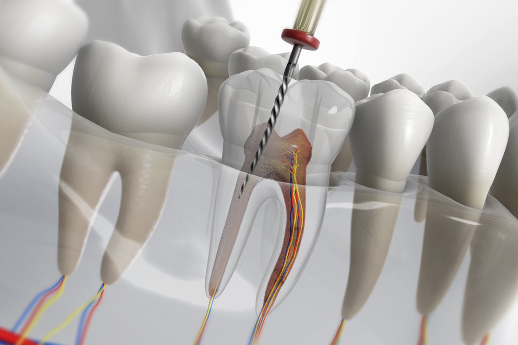 Передовые технологии в лечение каналов и корней зубов с клиникой Персона-Дент